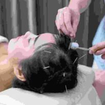 Hair Transplant Treatment